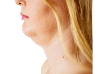 Liposukcja